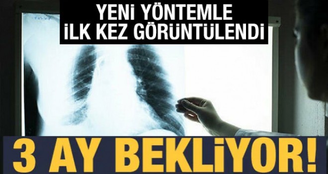 Kovid-19 hastalarında 3 ay sonra ortaya çıkıyor