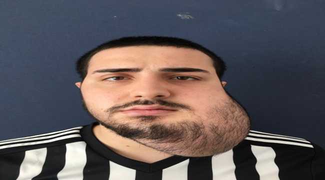 Yüzünün yarısı alınan hastaya bacağından yeni yüz yapıldı
