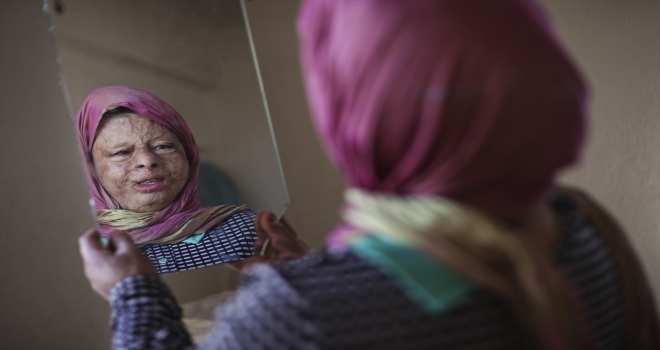 Savaşın yaralarından kurtulmak için 7 yılda 40 ameliyat oldu