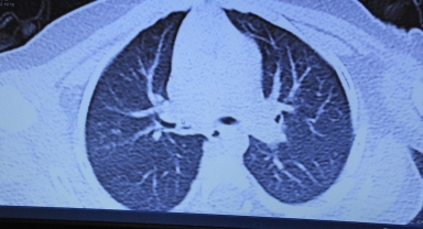 Küçük Yusuf akciğerindeki 