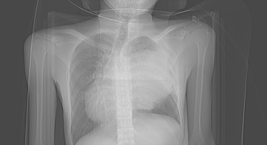 Endonezyalı turist tatil için geldiği Alanya'da göğsündeki 3 kiloluk kitleden kurtuldu