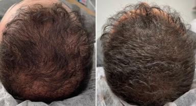 Saç Simülasyonu Nedir?