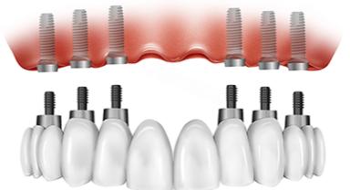All-on-6 implant treatment in Antalya 