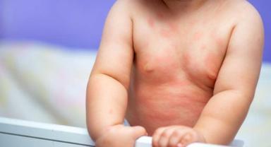 Çocuklarda Döküntü Neden Olur?