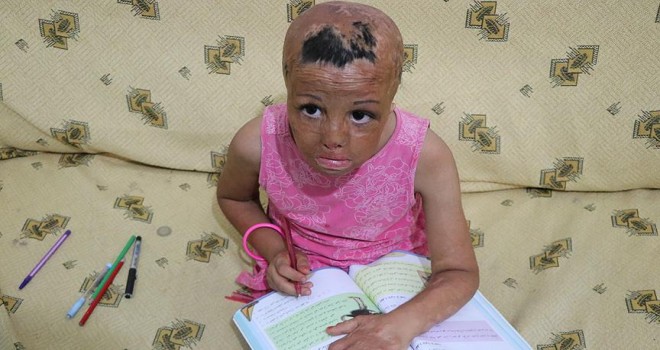 Üç Yılda 93 Ameliyat Geçirdiği