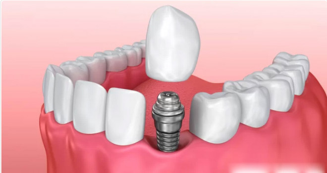 İmplant Tedavi Süreci ve Yapımı