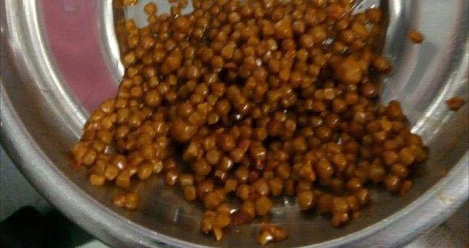 Safra Kesesinden 710 Adet Taş Çıktı